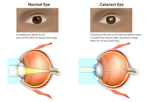 Cataract Surgery