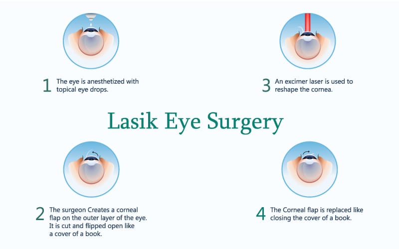 lasik-surgery